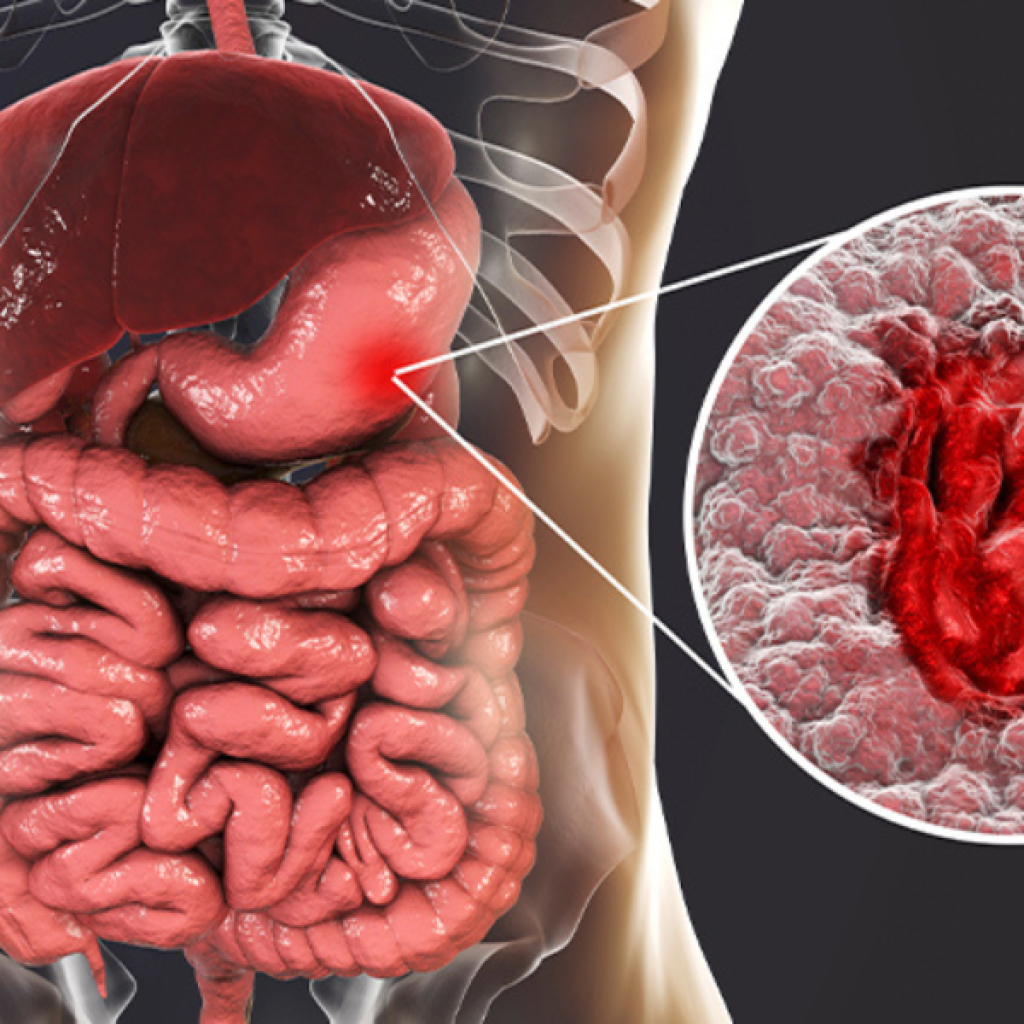 Unveiling the Causes of Stomach Ulcers: A Deep Dive into a Common Condition